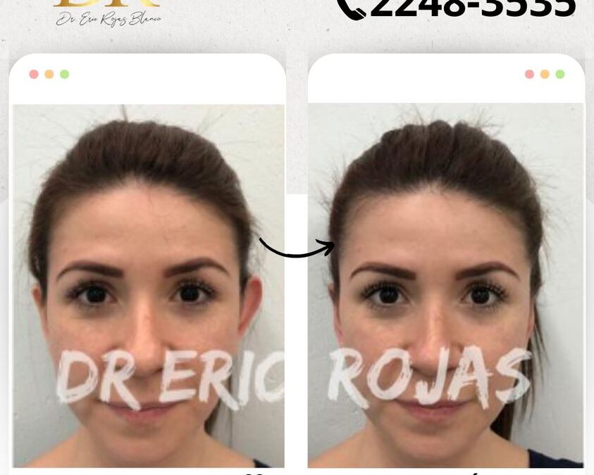 Dermo Otoplastía, corrección de orejas.
