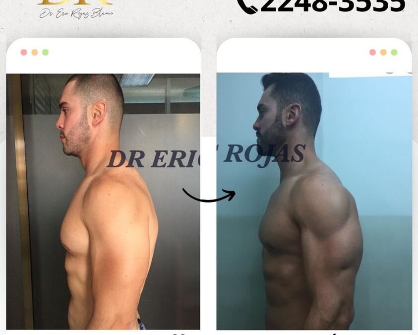 lim láser genera excelentes resultados en marcaje.