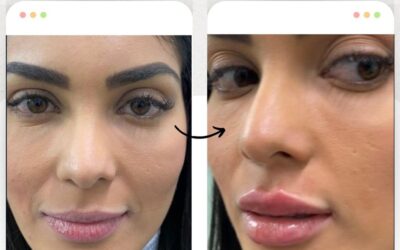 Relleno de Labios con el mejor precio $399 USD, visítanos.