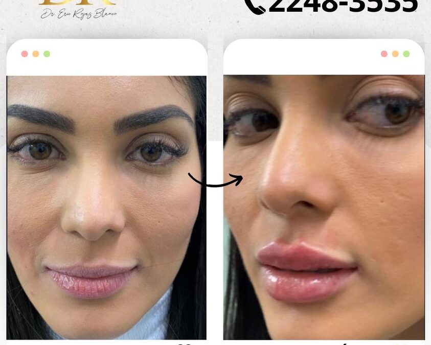 Relleno de Labios con el mejor precio $399 USD, visítanos.