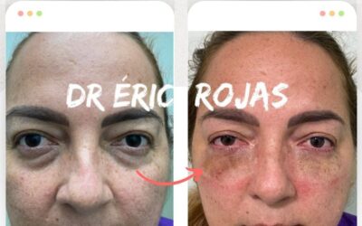 Despídete de las Ojeras con nuestra técnica.
