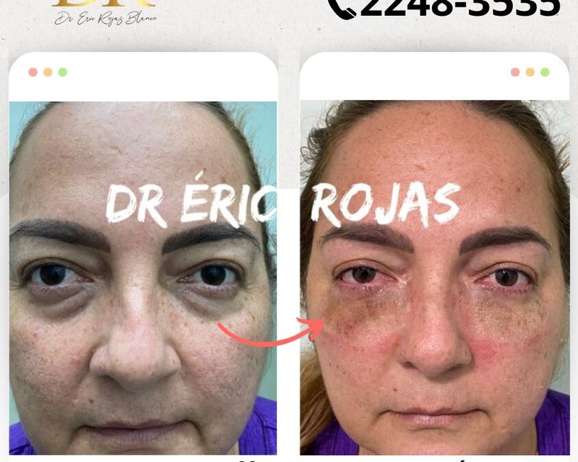 Despídete de las Ojeras con nuestra técnica.