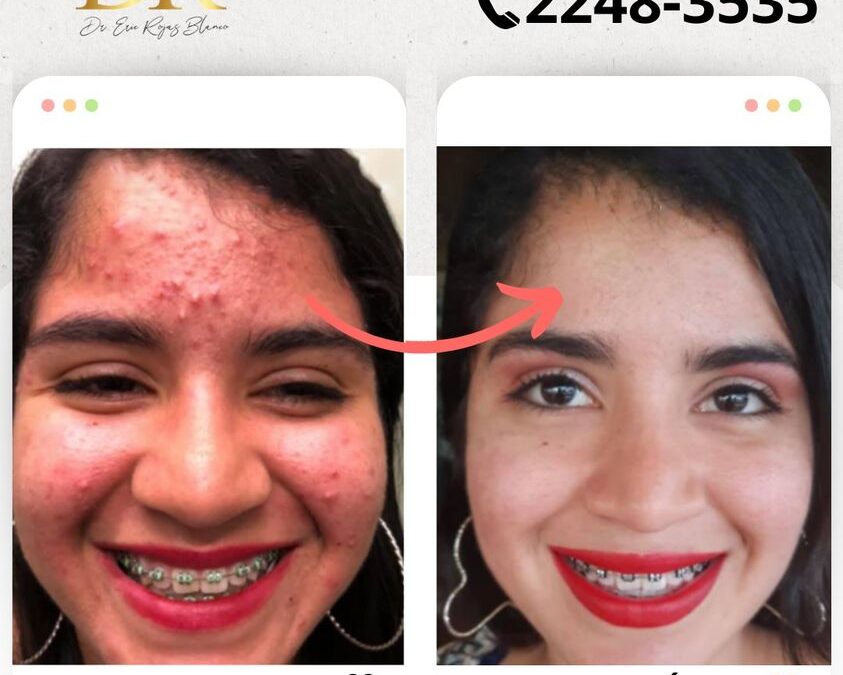 Elimina el acné de tu vida, contamos con el mejor tratamiento garantizado.