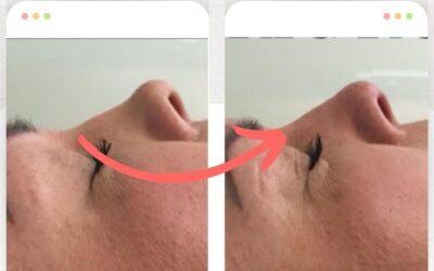 Mejora tu perfil con Rinolift, el mejor procedimiento.