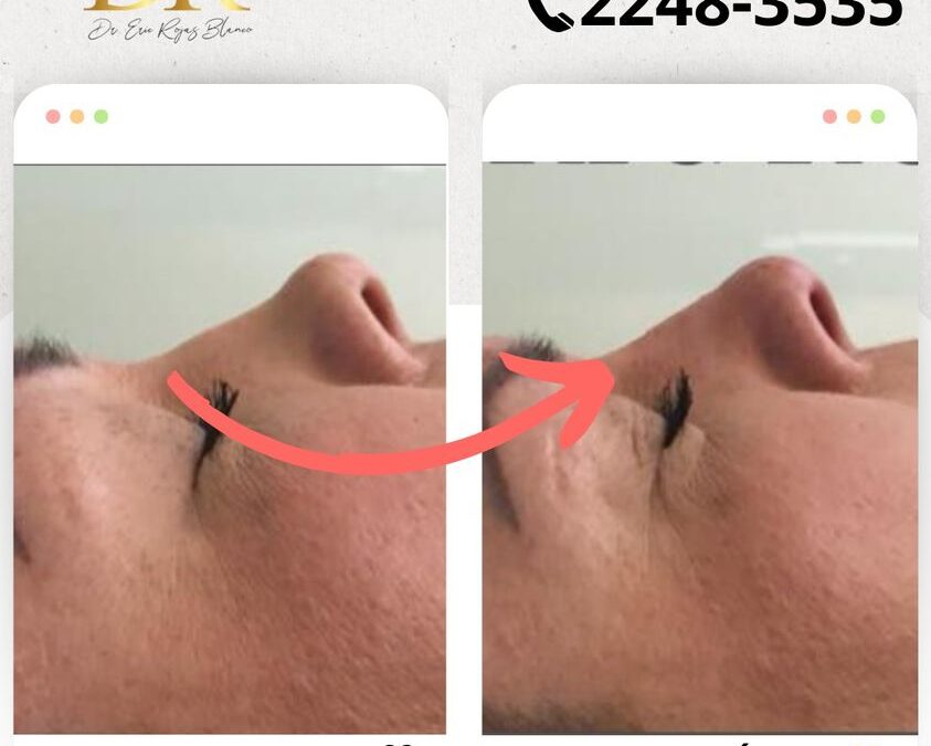 Mejora tu perfil con Rinolift, el mejor procedimiento.
