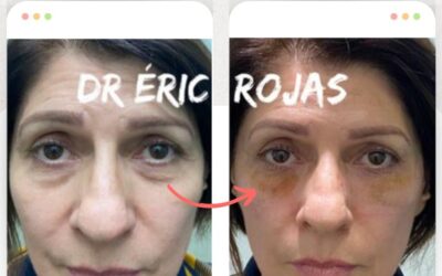 Elimina las Ojeras y luce renovada/o