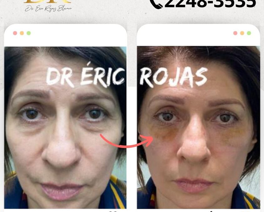 Elimina las Ojeras y luce renovada/o