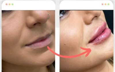 Relleno de labios es la manera para lucir tus increíbles labios.