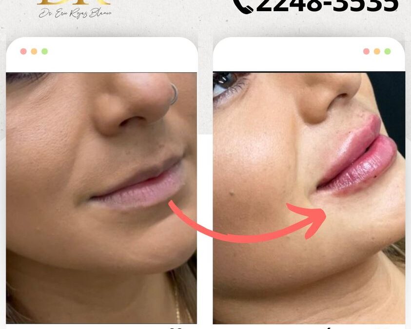 Relleno de labios es la manera para lucir tus increíbles labios.