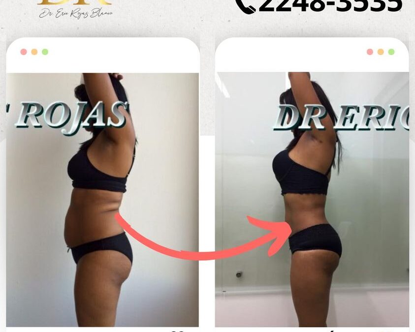 Logramos mejorar inmensamente la flacidez de nuestra paciente.