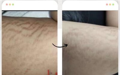 Elimina las estrías de tu cuerpo.