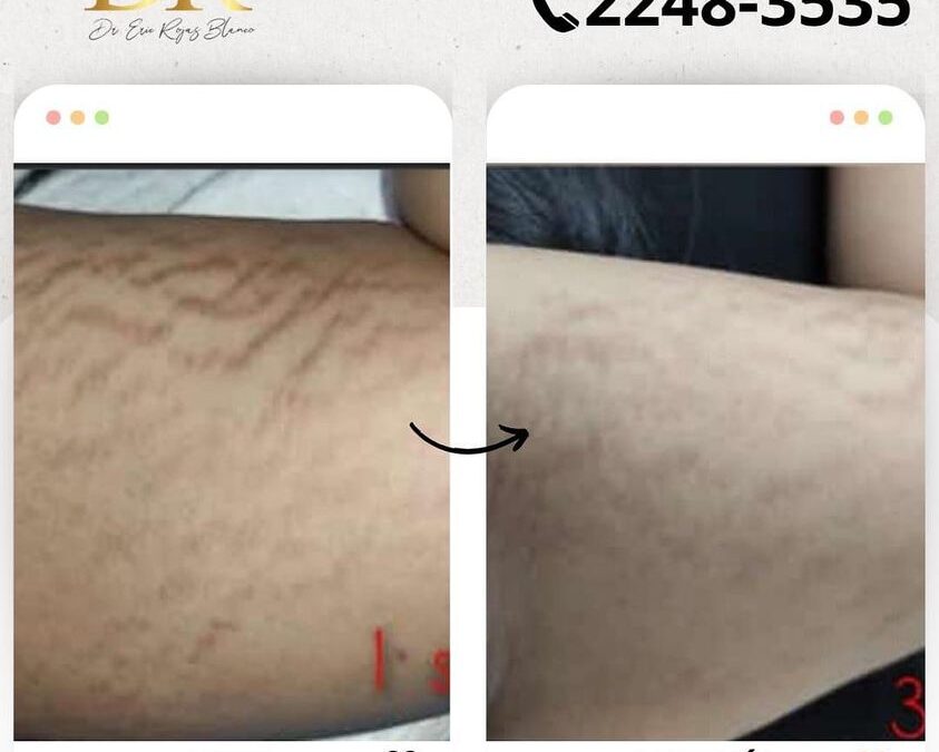Elimina las estrías de tu cuerpo.