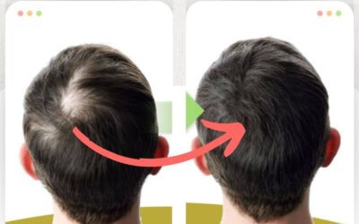 Podemos solucionar tu Alopecia.