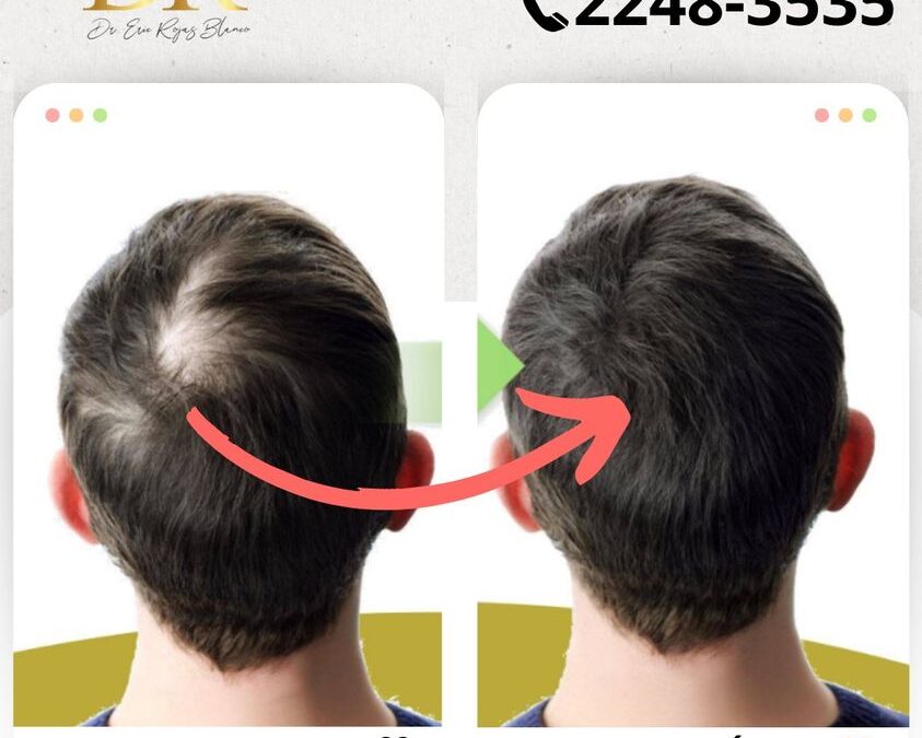 Podemos solucionar tu Alopecia.