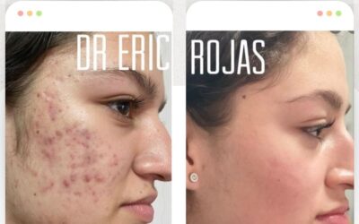 Limpia tu rostro, elimina el acné y recupera tu seguridad