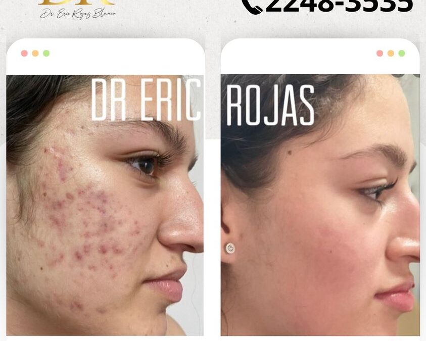 Limpia tu rostro, elimina el acné y recupera tu seguridad