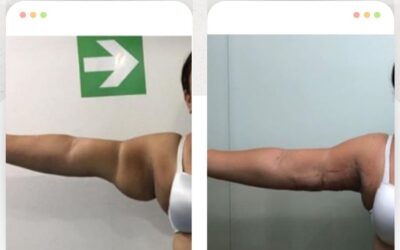 Solucionamos el exceso de piel, con la mejor técnica.