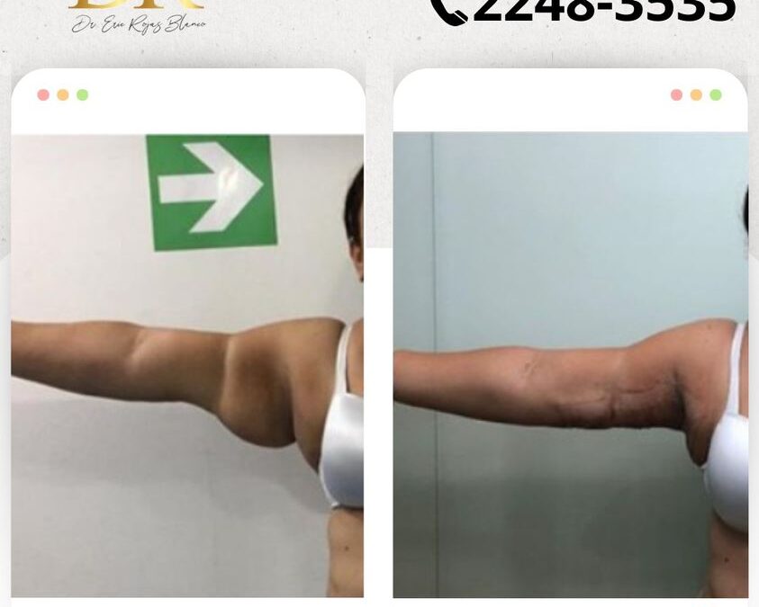 Solucionamos el exceso de piel, con la mejor técnica.