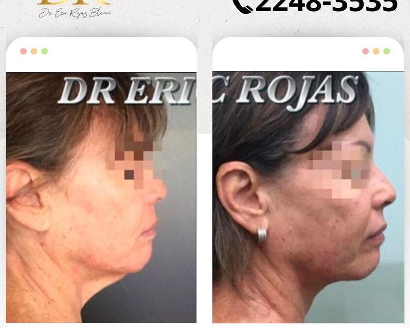 Slim Láser papada, luce genial con un solo procedimiento.👇
