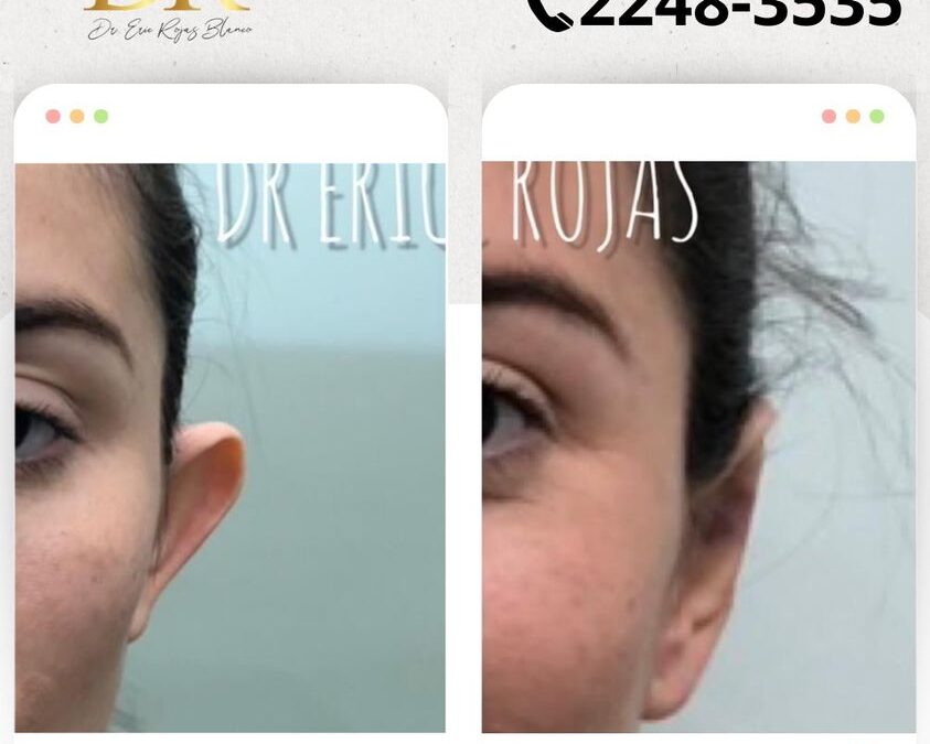 Dermo Otoplastía en un increíble precio, por solo $950 USD.