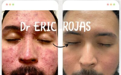 Nuestras consultas dermatologicas o valoraciones tienen un precio de 45,000 colones.