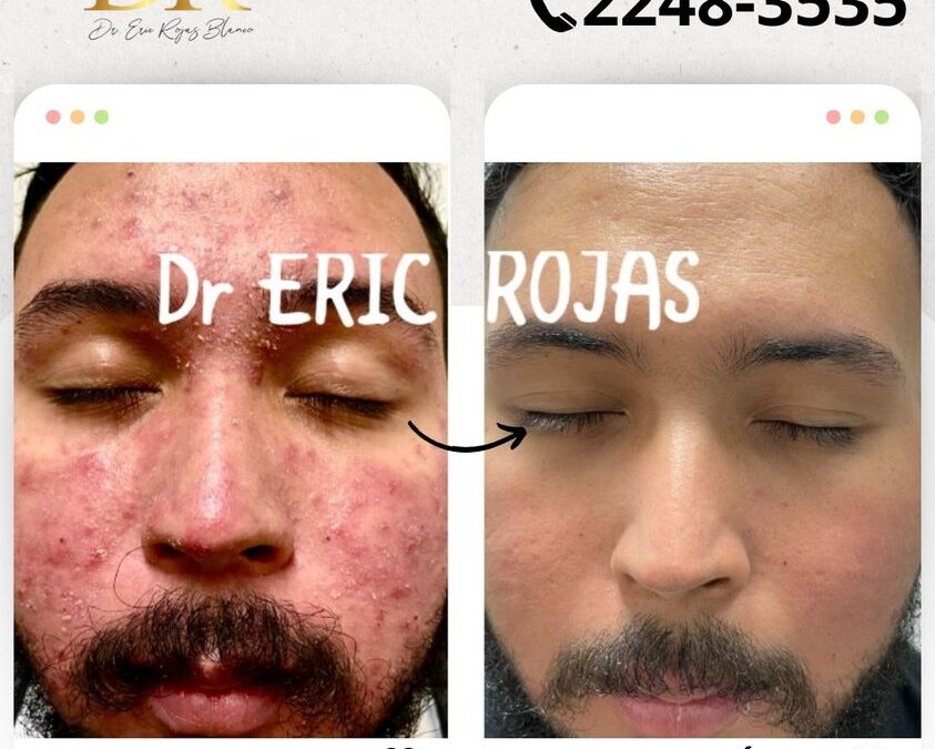 Nuestras consultas dermatologicas o valoraciones tienen un precio de 45,000 colones.