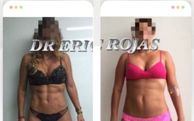 Abdomen con Slim láser.