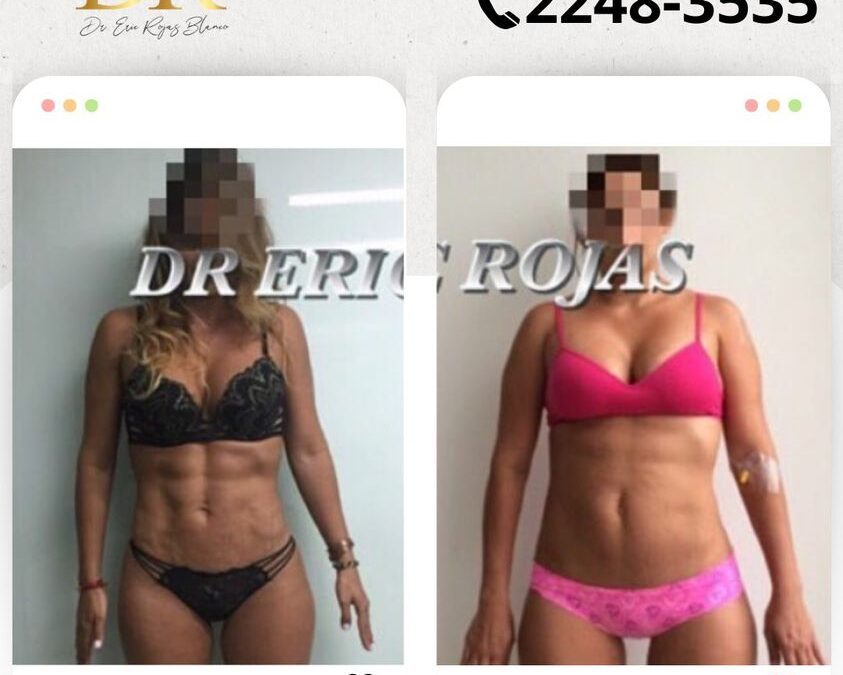 Abdomen con Slim láser.