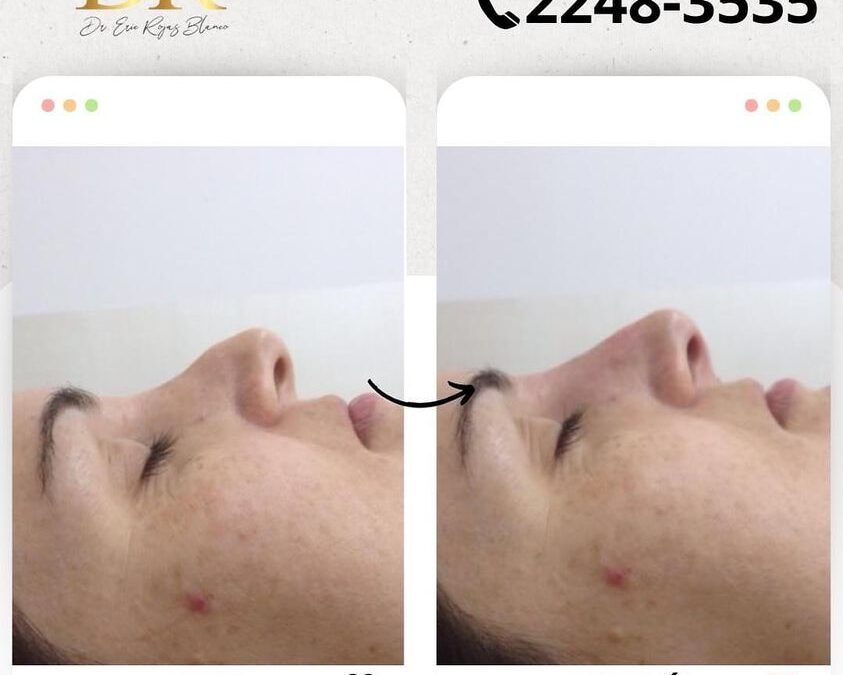 Increíble cambio en el perfil de tu nariz con rinolift