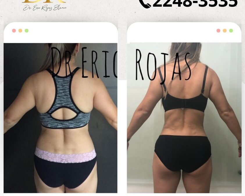 Slim Láser genera los resultados que tanto deseas.