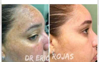 ¿Tienes manchas en tu rostro?, Es posible limpiar tu rostro.🆒👇