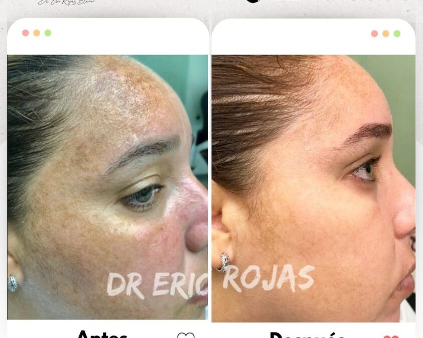 ¿Tienes manchas en tu rostro?, Es posible limpiar tu rostro.🆒👇