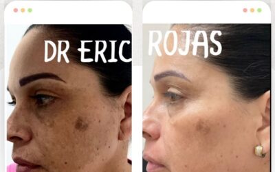 Elimina las manchas de tu rostro.👇