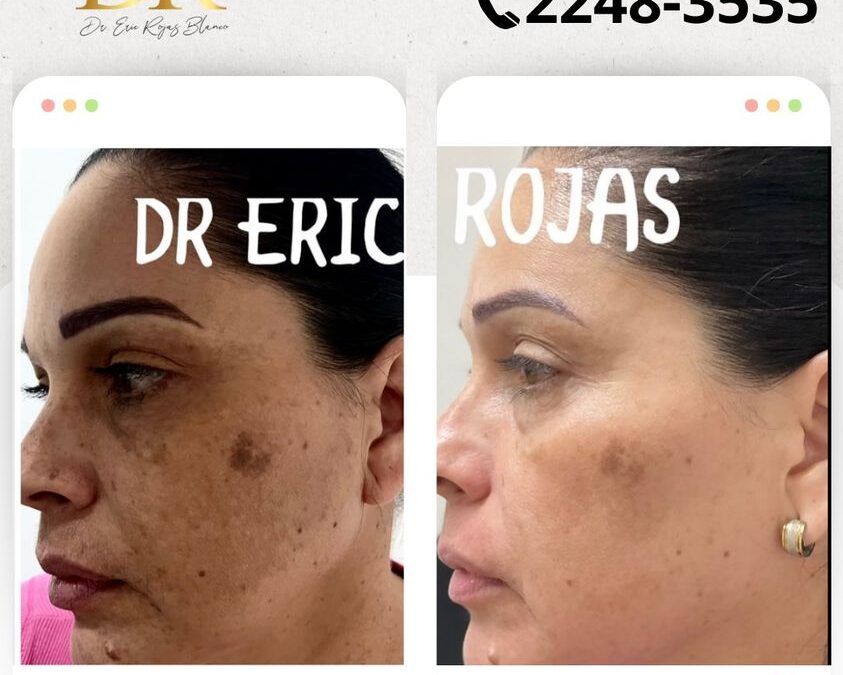Elimina las manchas de tu rostro.👇