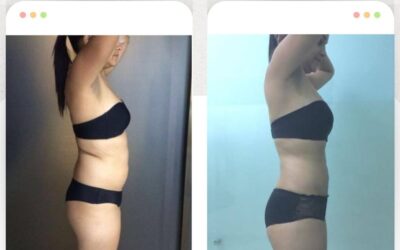 Increíbles resultados con el mejor procedimiento, Slim Láser.