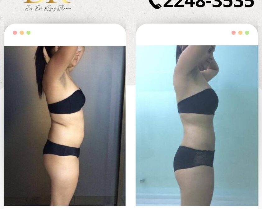 Increíbles resultados con el mejor procedimiento, Slim Láser.
