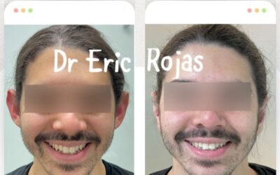 Dermo Otoplastía, la mejor técnica para corregir tus orejas.