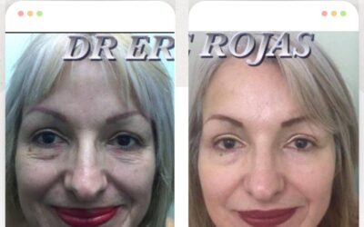 Rejuvenece tu rostro sin cirugía, nosotros logramos mejorar tu rostro.