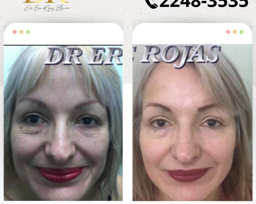 Rejuvenece tu rostro sin cirugía, nosotros logramos mejorar tu rostro.