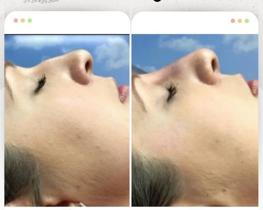 | Rinolift, la mejor manera de mejorar tu perfil.