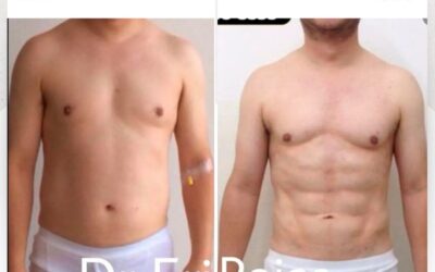 Marcaje abdominal con Slim Láser. 😉