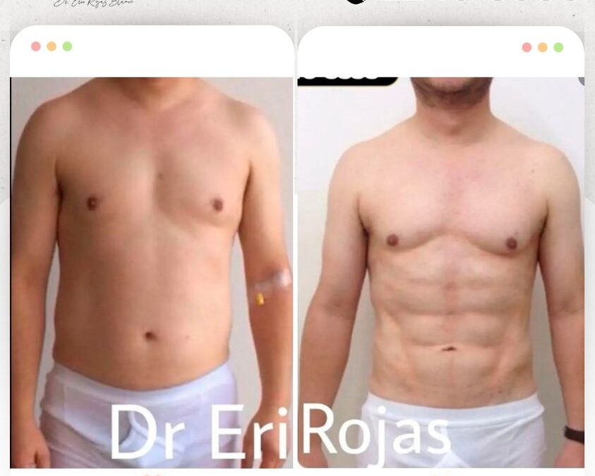 Marcaje abdominal con Slim Láser. 😉