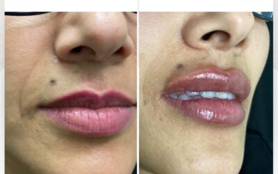 Relleno de labios en Promoción $400 USD