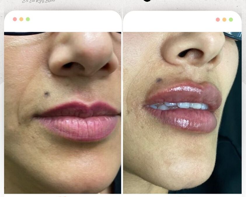 Relleno de labios en Promoción $400 USD