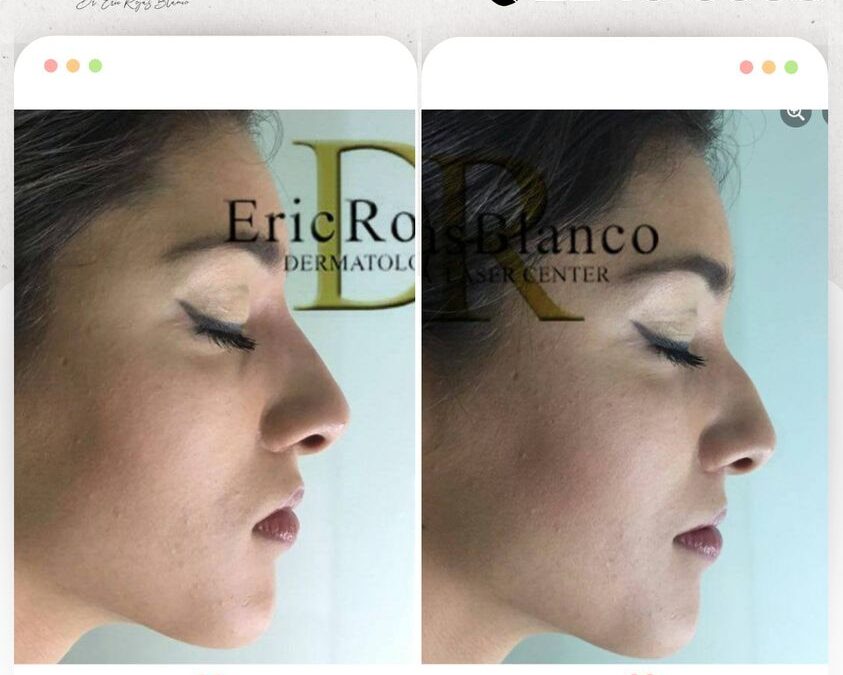 Rinolift, la mejor manera para corregir el perfil de tu nariz.