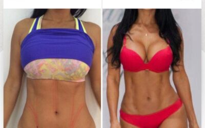 Slim Láser abdomen