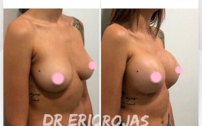 Aumento de mamas, el cambio que deseas.