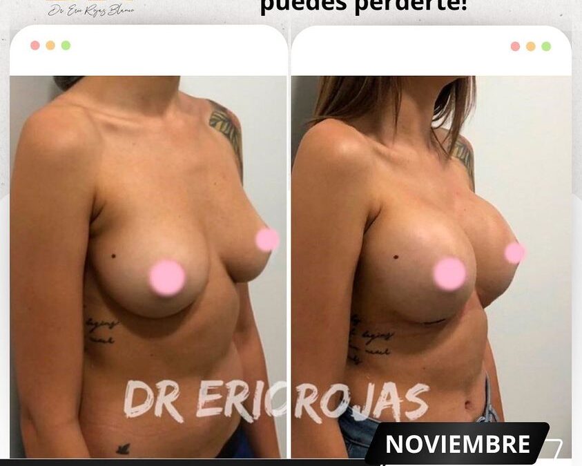 Aumento de mamas, el cambio que deseas.