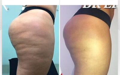 Elimina la celulitis, tenemos el mejor método.