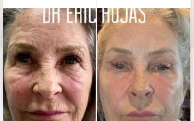 Rejuvenecimiento Facial, la mejor técnica del país.